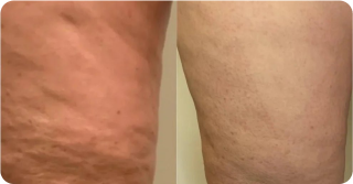 Stretch Marks