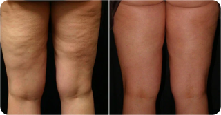 Cellulite Reduction