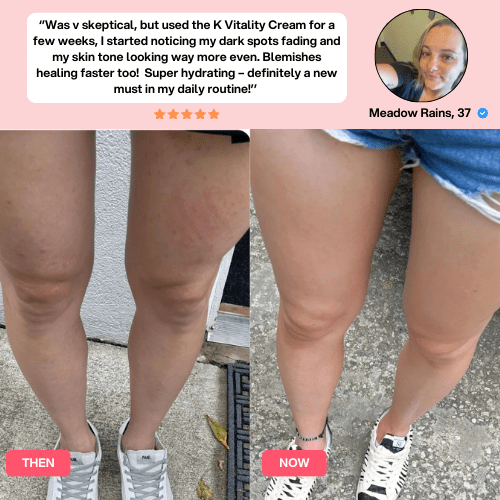 K-Vitality Cream™ (Anti-Spider Veins, Bruising & Dark Spots)