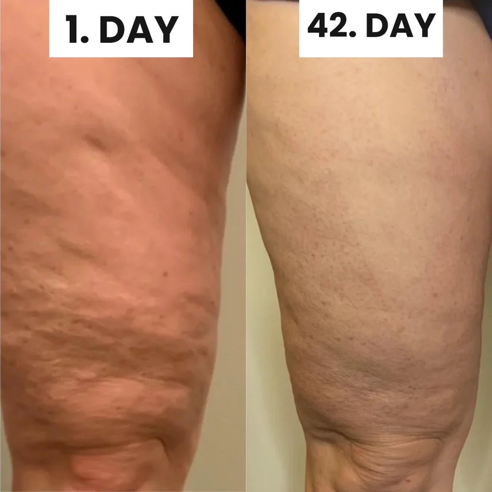 SheVitality™ Cellulite Relief In 30 Days